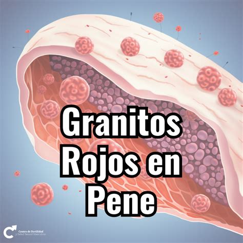 granitos en el oene|Granos en el pene: 14 causas y cómo tratarlos